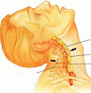 cervikalna osteohondroza liječenje boli u ramenu bol u dlanu zgloba