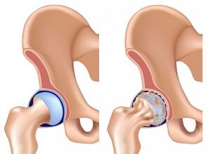 Artritis | Poliklinika Scipion