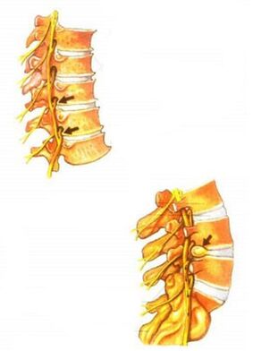 artroza u liječenju lumbosakralne kralježnice da se smanji bol u zglobovima