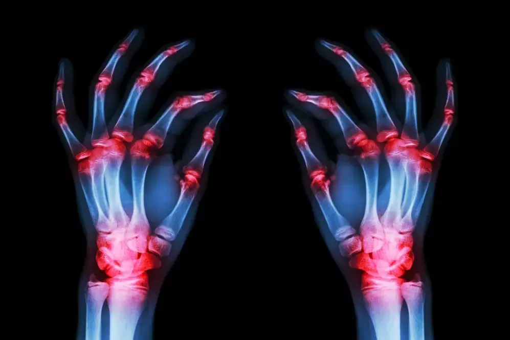 artroza zglobova prstiju