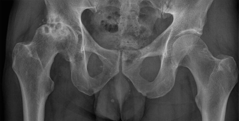 Artroza zgloba kuka 3. stupnja na rendgenskoj snimci