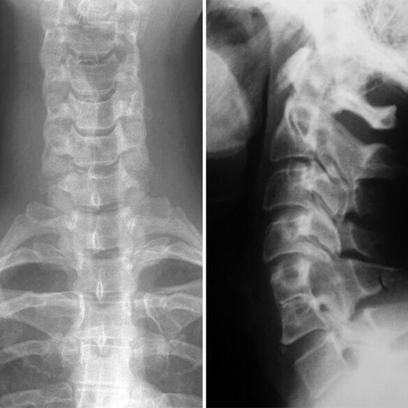 X -Ray od kralježnice grlića maternice