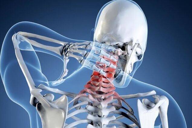 Osteohondroza cervikalne regije