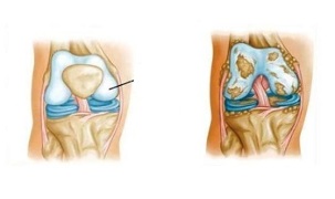 patološke promjene u artrozi koljena