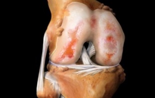 što je artroza koljena