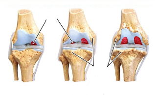 faze artroze koljena