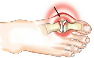 Upala zgloba između palca i stopala kod artritisa
