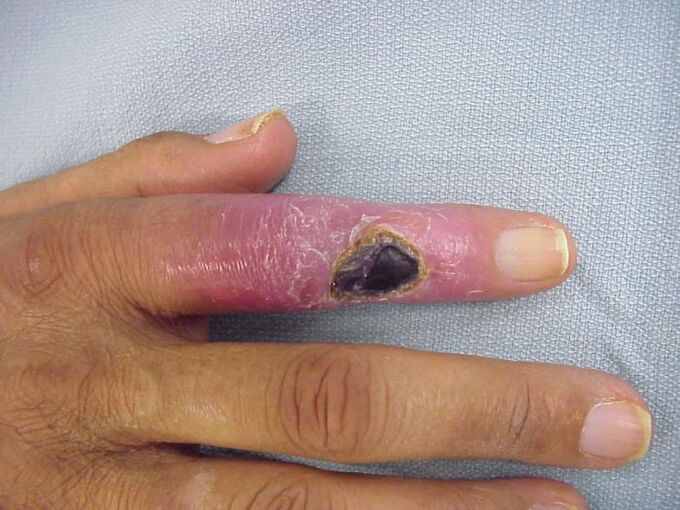 osteomijelitis kao uzrok boli u zglobovima prstiju