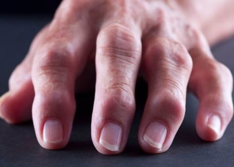 reumatoidni artritis kao uzrok boli u zglobovima prstiju