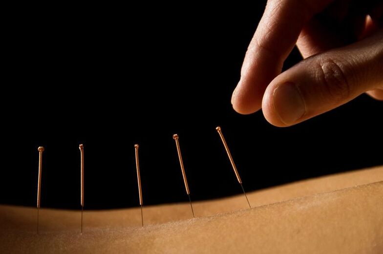 akupunktura za bolove u leđima