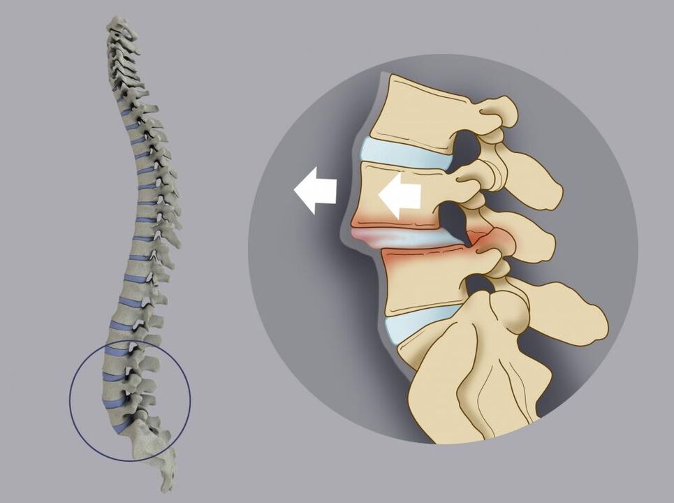 pomak kralježaka kao uzrok bolova u leđima