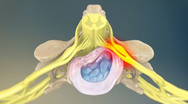 radikularni sindrom kao uzrok bolova u leđima