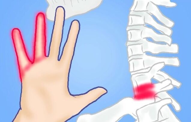 uklješteni živci kao uzrok bolova u leđima