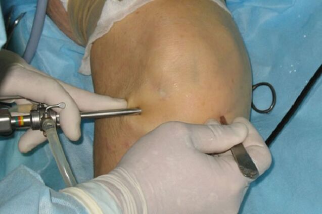 artroskopija za bol u koljenu
